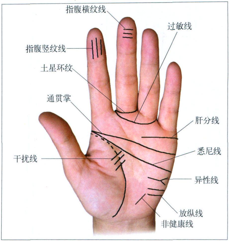 (二)手掌病理掌纹线(图5